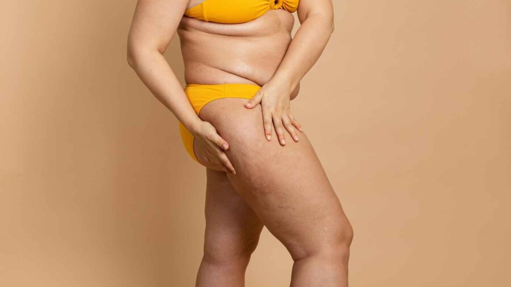 lipedema